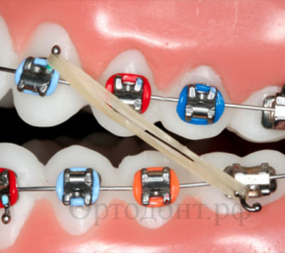 эластики в ортодонтии