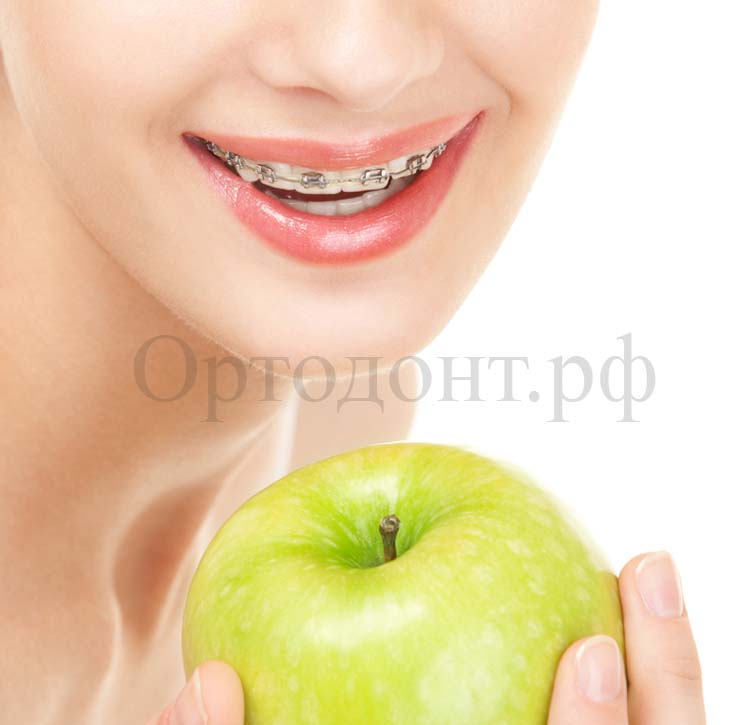 исправление кривых зубов
