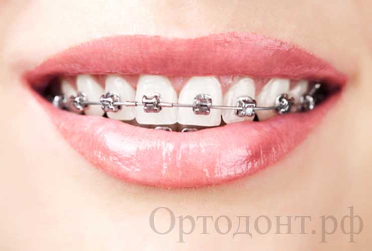 лечение в ортодонтии