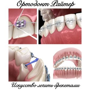 зубные брекеты